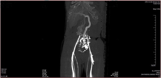 CT angiography image demonstrating absence of the infra- and suprarenal portions ...