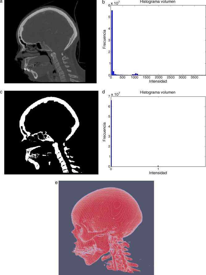 Técnica de umbralización aplicada a imágenes de TC cráneo-facial. (a) Vista ...