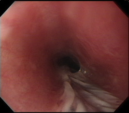 Endoscopic view of the esophagus showed a longitudinal, whitish, detached ...