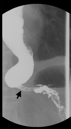 Esophagogram demonstrating a markedly dilated esophagus with a “bird beak” ...