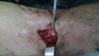 Pie-crusting, make several staggered rows of cuts in the tendon.