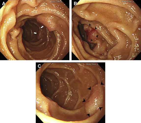 (A) Multiple round, sessile, button-like polyp lesions with a slight central ...