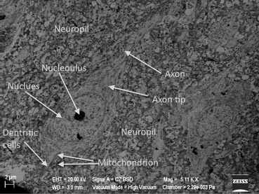 Normal neuron and neuropil in Group I.