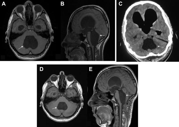 Preoperative (A) axial and (B) sagittal T1-weighted magnetic resonance imaging ...