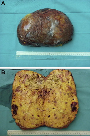 (A) Hepatic angiomyolipoma. (B) Cut surface showing tumor with adipose tissue, ...