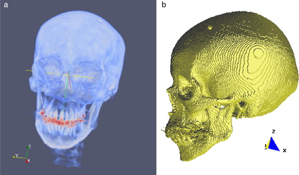 Vistas volumétrica del modelo del cráneo. (a) Vista del volumen original en ...