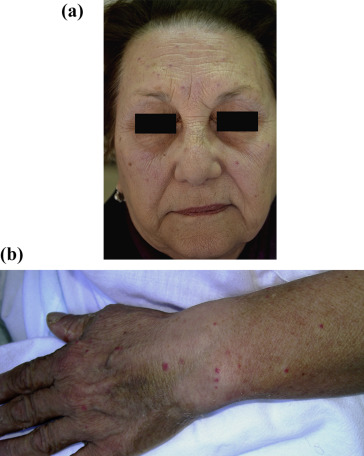 (a) Telangiectasia widely distributed on the face. (b) Forearms and on the dorsa ...