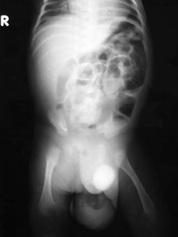 Abdominal radiography showing distended small bowel enteric loops and the ...