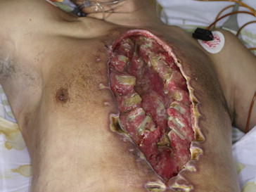 Patient with whole sternum necrosis and heart exposure prior to debridement.