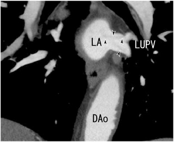 A 64-MDCT scan showed coronal images of thrombi in the LUPV (arrowheads). DAo: ...